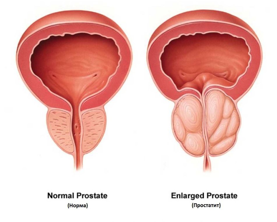 Хроническая простата аденома. Воспаление предстательной железы. Острый и хронический простатит.